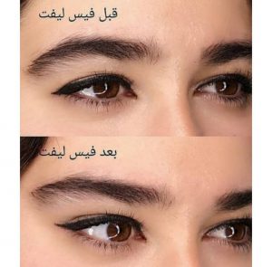 کش لیفت شقیقه